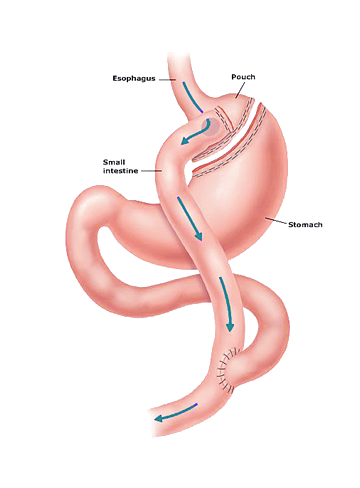Gastric-Bypass-Image-2014