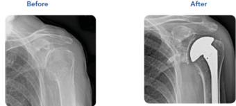Shoulder-Surgery-Bone