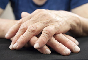 osteoarthritis hands