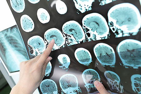 brain-CT-scan brain ct scan