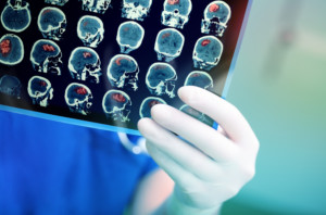 doctor looks at scans from stroke patient