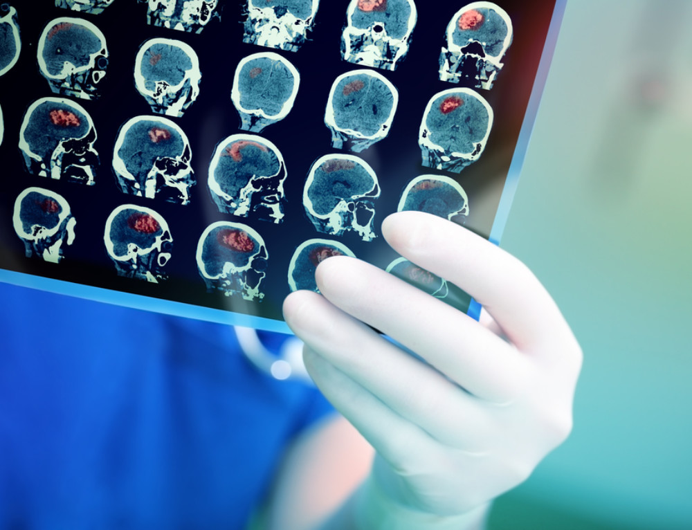 Side Effects of a Stroke [INFOGRAPHIC] TriCity Medical Center