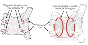 pulmonary veins atrial fibrillation