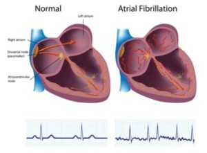 normal heart versus atrial fibrillation heart