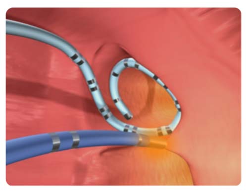 radiofrequency catheter ablation