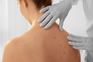 A woman gets checked for skin cancer